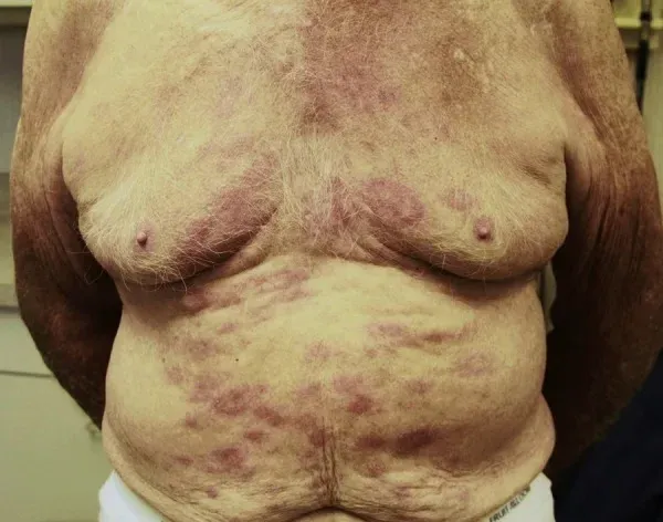 OMS ignoră posibila legătură dintre vaccinurile ARNm și explozia cazurilor de cancer